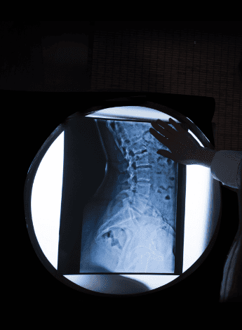 An x-ray of a spine